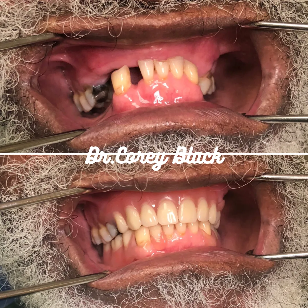 Patient smile transformation 2 at SmileSpace