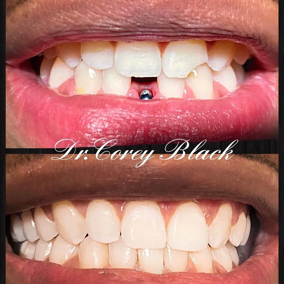 Patient smile improvement at SmileSpace
