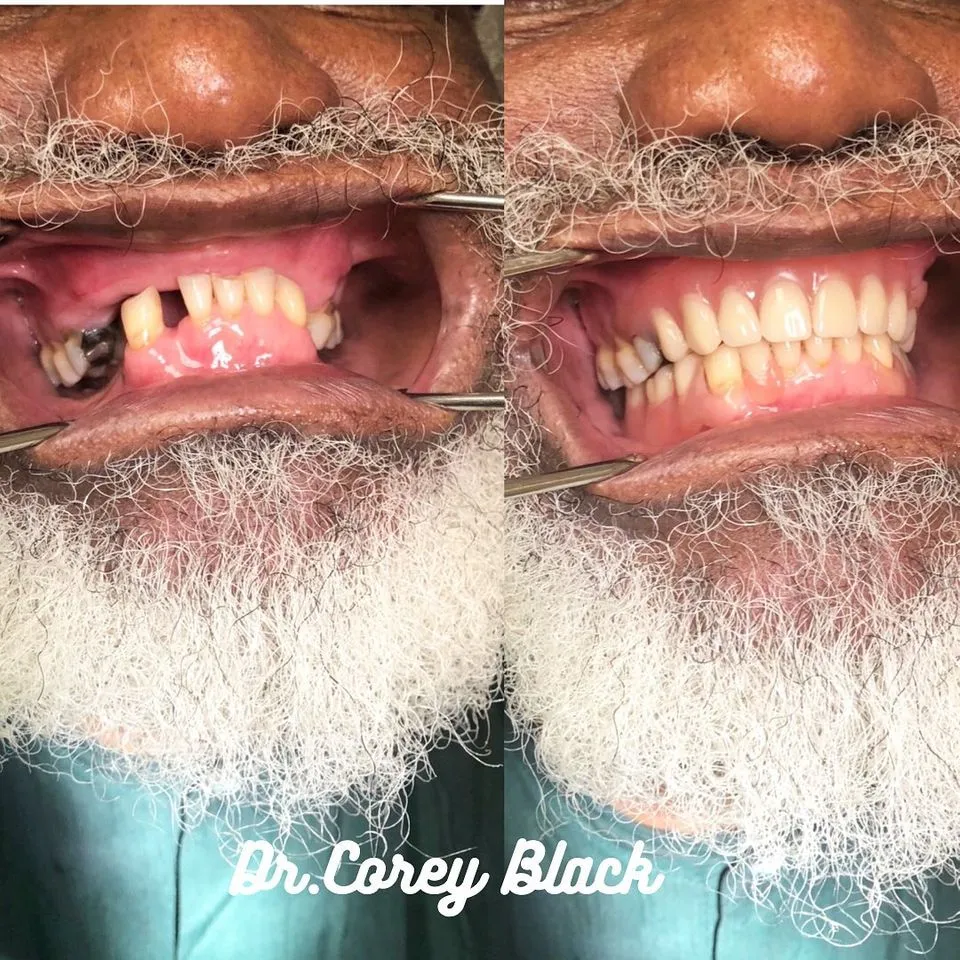 Dental restoration results at SmileSpace