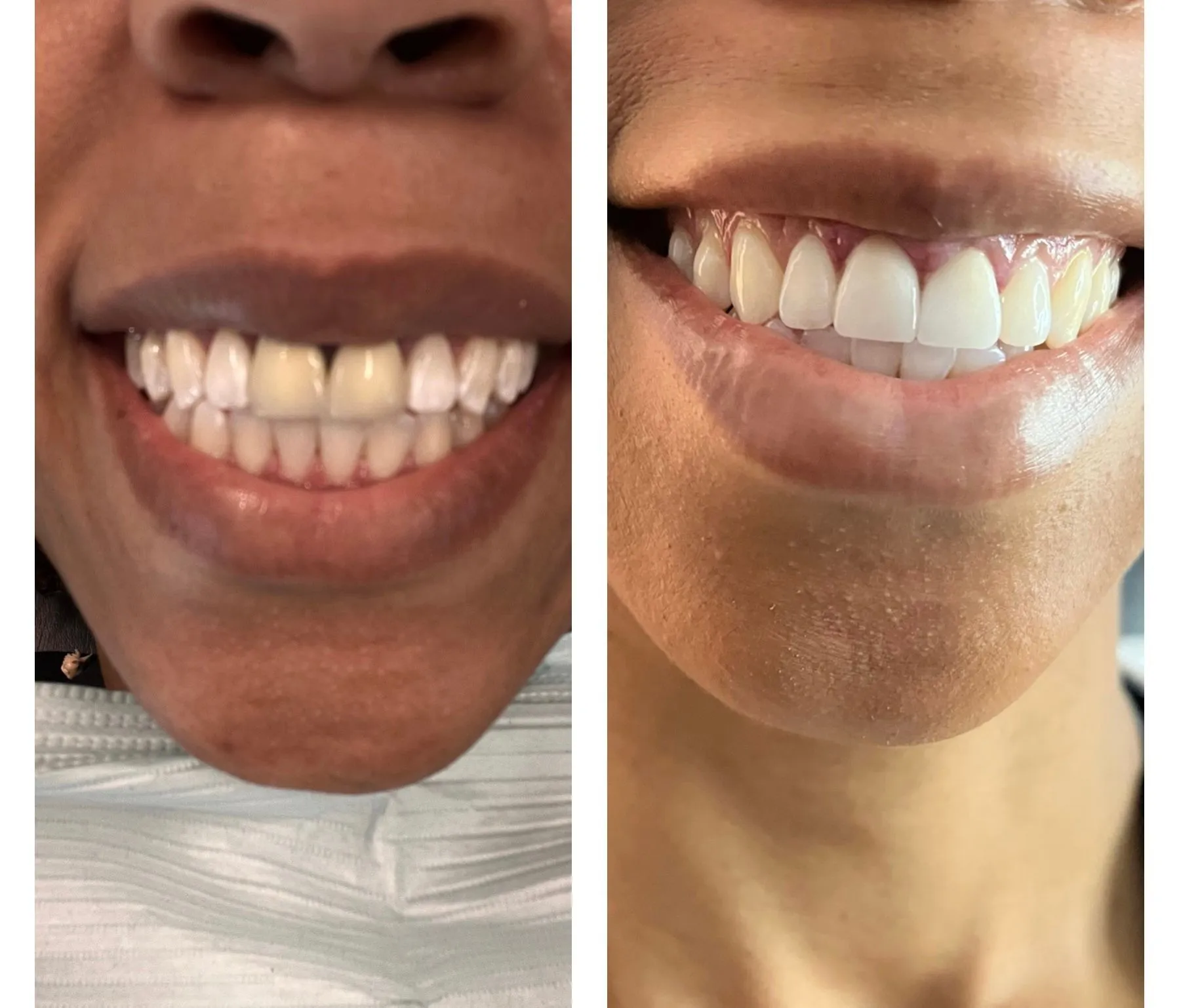 Patient smile transformation 13 at SmileSpace