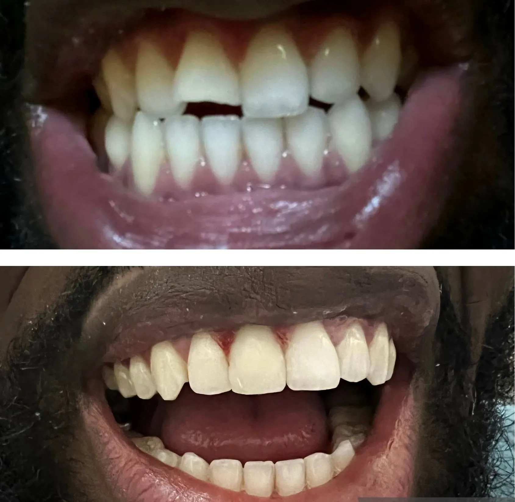 Patient smile transformation 14 at SmileSpace