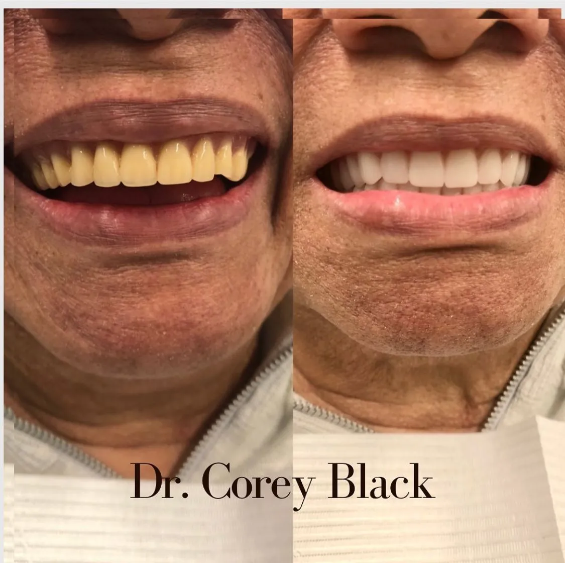 Patient smile transformation 16 at SmileSpace