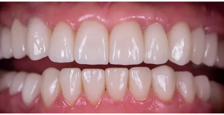 After - Smile transformation