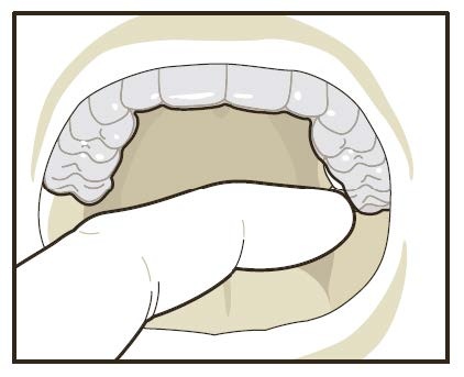 Aligners 3