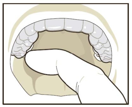 Aligners 4