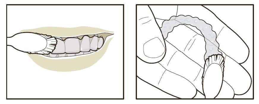 Aligners 6